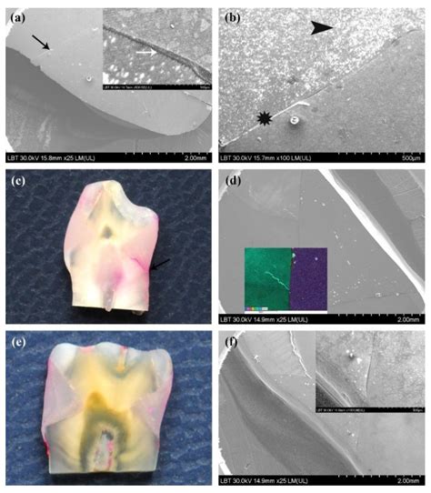 coronal margin adhesion